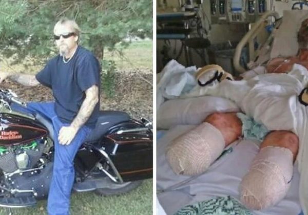 man-loses-limbs-after-dog’s-lick-transmits-rare-bacteria