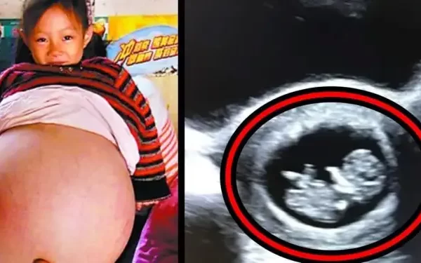 8-year-old-girl-is-told-she-looks-pregnant-in-school.-her-parents-rush-her-for-an-ultrasound