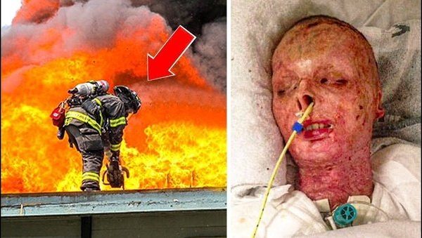 this-firefighter-lost-his-face-in-fire-to-save-a-woman,-you-won’t-believe-what-he-looks-like-today